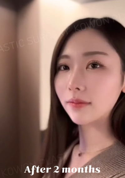 낮은코수술, 코끝 교정으로 개선 성공! 사진 후기 사진 9