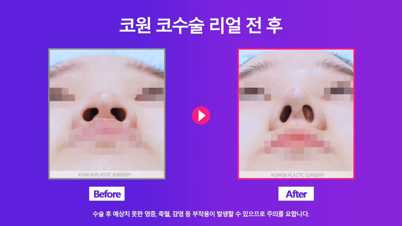 코끝 처진코/화살코 개선을 위해 코끝내림근 제거한 사례 사진 7