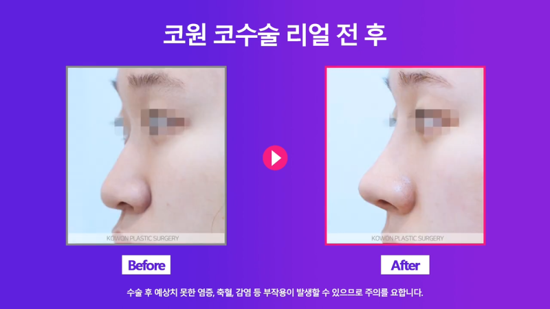 코끝 처진코/화살코 개선을 위해 코끝내림근 제거한 사례 사진 8