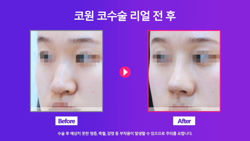 코끝 처진코/화살코 개선을 위해 코끝내림근 제거한 사례 사진 6