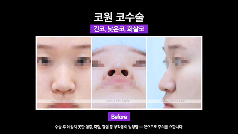 코끝 처진코/화살코 개선을 위해 코끝내림근 제거한 사례 사진 3