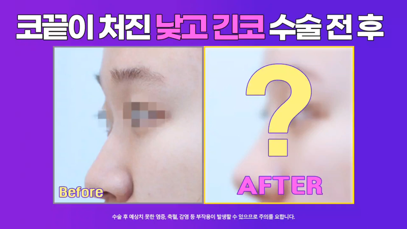코끝 처진코/화살코 개선을 위해 코끝내림근 제거한 사례