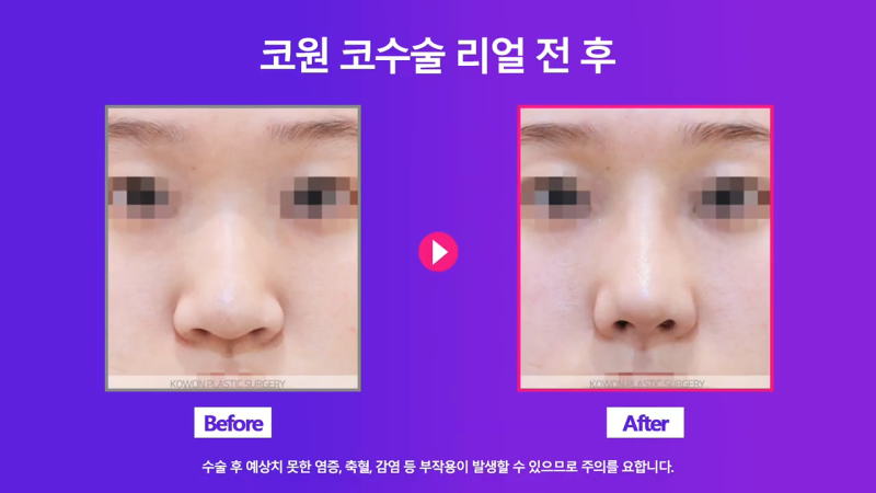 코끝 처진코/화살코 개선을 위해 코끝내림근 제거한 사례 사진 5