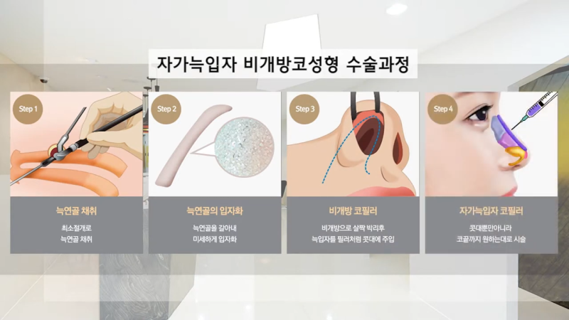 자가늑입자 비개방코성형, 수술 방법과 추천 대상은? 사진 5