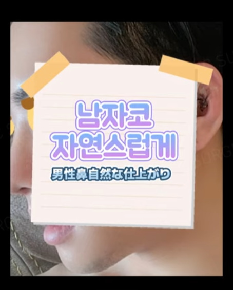 무보형물 남자코 첫수술 자연스러운 직선코, 무턱보형물 수술로 이미지 변화 성공했습니다.