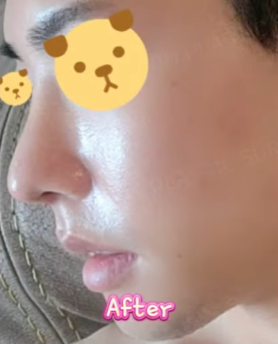 무보형물 남자코 첫수술 자연스러운 직선코, 무턱보형물 수술로 이미지 변화 성공했습니다. 사진 7