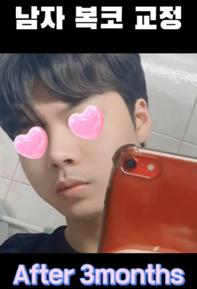 무보형물 남자코 첫수술 자연스러운 직선코, 무턱보형물 수술로 이미지 변화 성공했습니다. 사진 14