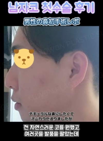 무보형물 남자코 첫수술 자연스러운 직선코, 무턱보형물 수술로 이미지 변화 성공했습니다. 사진 3
