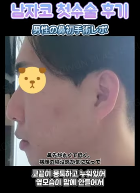 무보형물 남자코 첫수술 자연스러운 직선코, 무턱보형물 수술로 이미지 변화 성공했습니다.