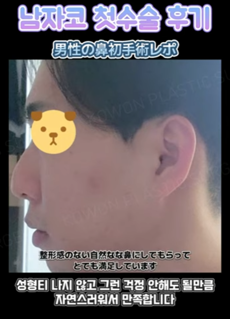 무보형물 남자코 첫수술 자연스러운 직선코, 무턱보형물 수술로 이미지 변화 성공했습니다. 사진 5
