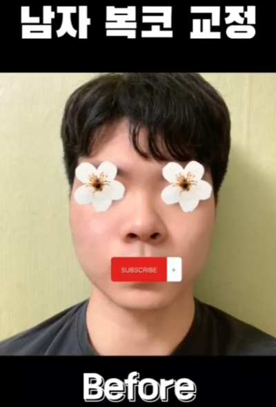 무보형물 남자코 첫수술 자연스러운 직선코, 무턱보형물 수술로 이미지 변화 성공했습니다. 사진 8