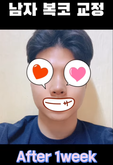 무보형물 남자코 첫수술 자연스러운 직선코, 무턱보형물 수술로 이미지 변화 성공했습니다. 사진 10