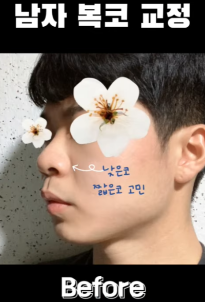 무보형물 남자코 첫수술 자연스러운 직선코, 무턱보형물 수술로 이미지 변화 성공했습니다. 사진 9