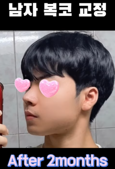 무보형물 남자코 첫수술 자연스러운 직선코, 무턱보형물 수술로 이미지 변화 성공했습니다. 사진 13