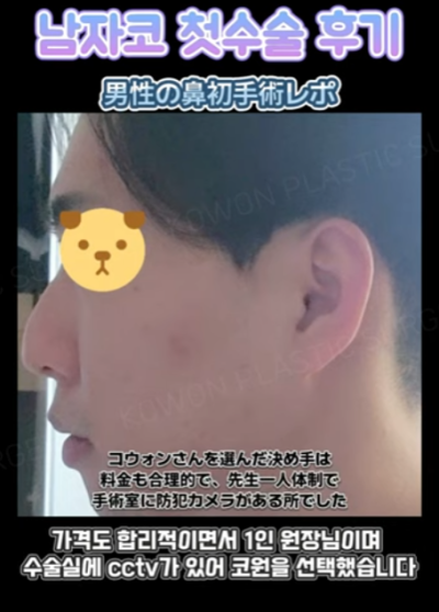 무보형물 남자코 첫수술 자연스러운 직선코, 무턱보형물 수술로 이미지 변화 성공했습니다. 사진 4