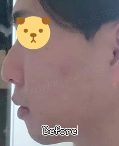 무보형물 남자코 첫수술 자연스러운 직선코, 무턱보형물 수술로 이미지 변화 성공했습니다. 사진 6