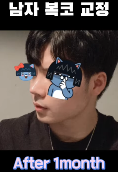 무보형물 남자코 첫수술 자연스러운 직선코, 무턱보형물 수술로 이미지 변화 성공했습니다. 사진 12