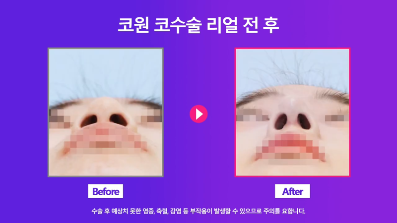 코끝교정과 코끝내림근 교정으로 낮은코 개선 성공한 사례 사진 6