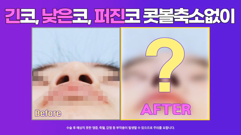 코끝교정과 코끝내림근 교정으로 낮은코 개선 성공한 사례