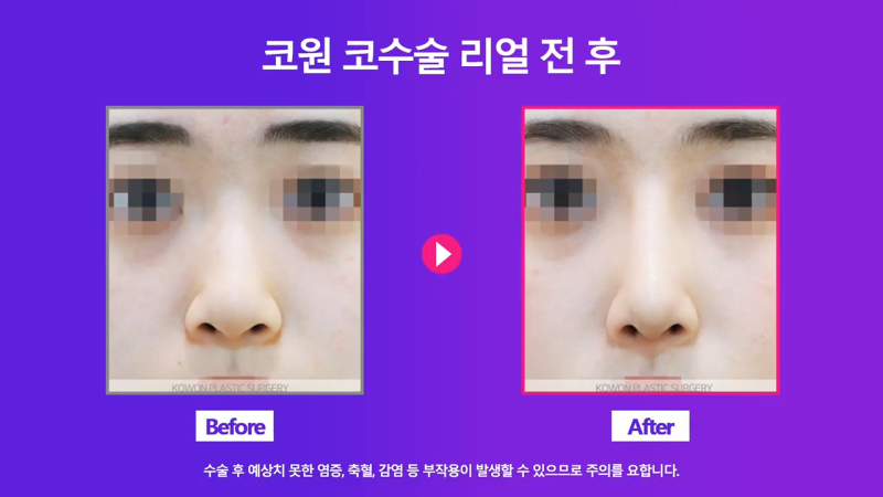 코끝교정과 코끝내림근 교정으로 낮은코 개선 성공한 사례 사진 5