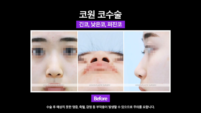 코끝교정과 코끝내림근 교정으로 낮은코 개선 성공한 사례 사진 4