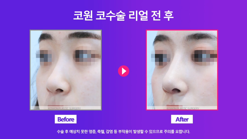 코끝교정과 코끝내림근 교정으로 낮은코 개선 성공한 사례 사진 7