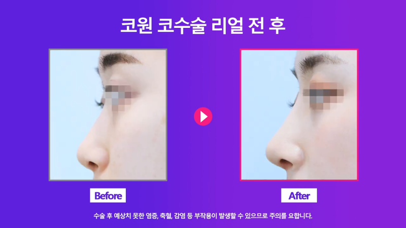코끝교정과 코끝내림근 교정으로 낮은코 개선 성공한 사례 사진 8