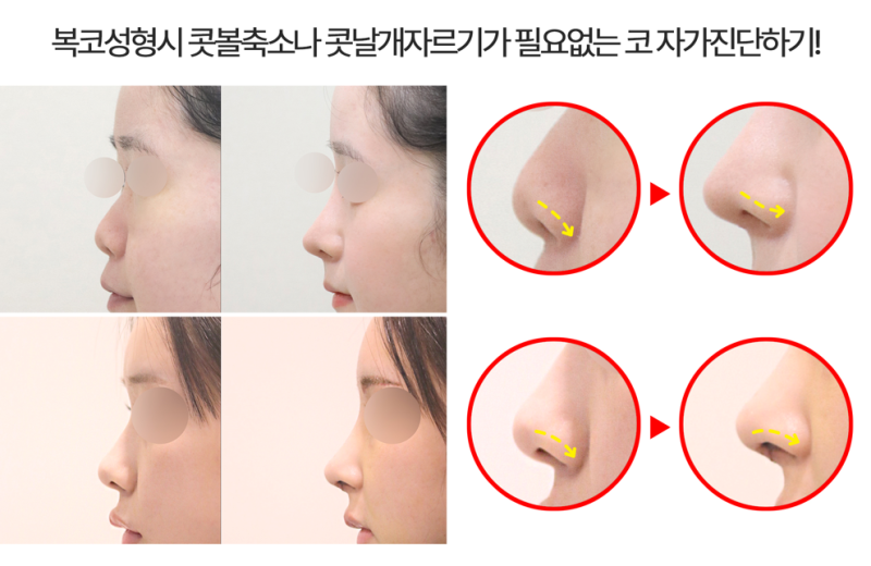 복코수술 콧볼축소, 콧날개자르기가 필요 없는 코 진단하기