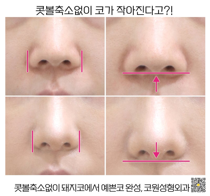 짧고 퍼진 들창코 콧볼 축소 없이 개선이 가능할까? 신사역성형외과에서 알려드립니다.