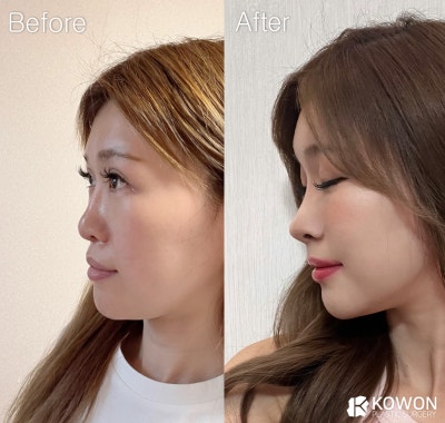 코수술로 ‘중안면 함몰 개선’ 가능 – 코원성형외과 - 사진 5