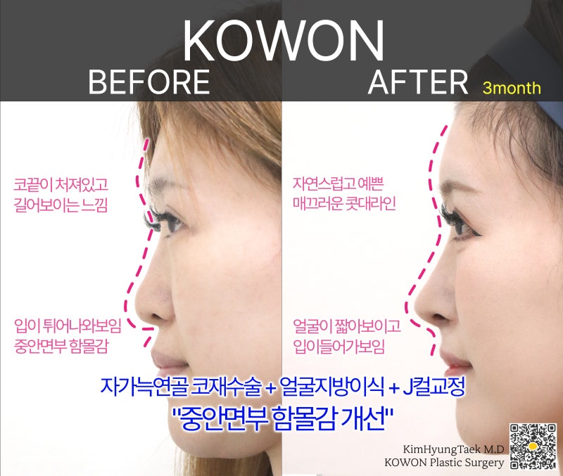 코수술로 ‘중안면 함몰 개선’ 가능 – 코원성형외과 - 사진 3