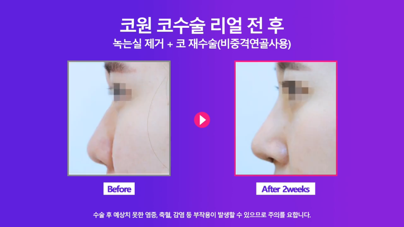 코재수술, 코실제거 후 비중격 연골을 사용해 코끝 올린 사례 사진 8