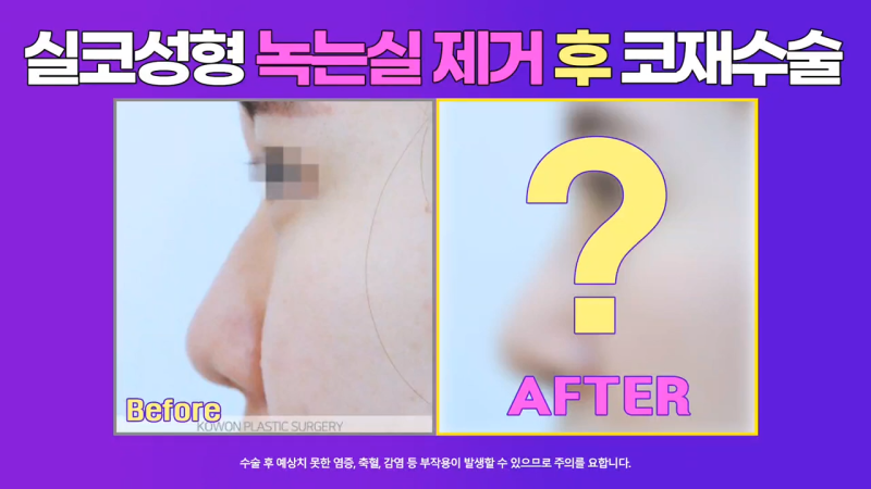 코재수술, 코실제거 후 비중격 연골을 사용해 코끝 올린 사례