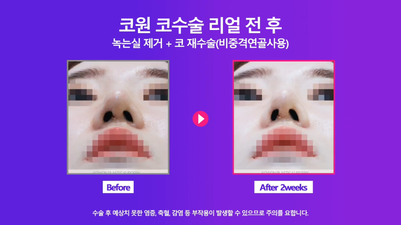 코재수술, 코실제거 후 비중격 연골을 사용해 코끝 올린 사례 사진 6