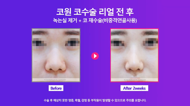 코재수술, 코실제거 후 비중격 연골을 사용해 코끝 올린 사례 사진 5