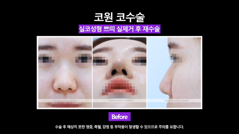 코재수술, 코실제거 후 비중격 연골을 사용해 코끝 올린 사례