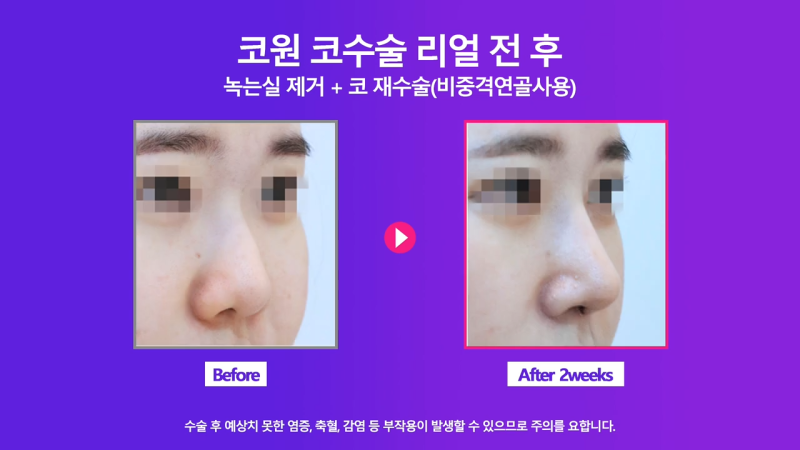 코재수술, 코실제거 후 비중격 연골을 사용해 코끝 올린 사례 사진 7