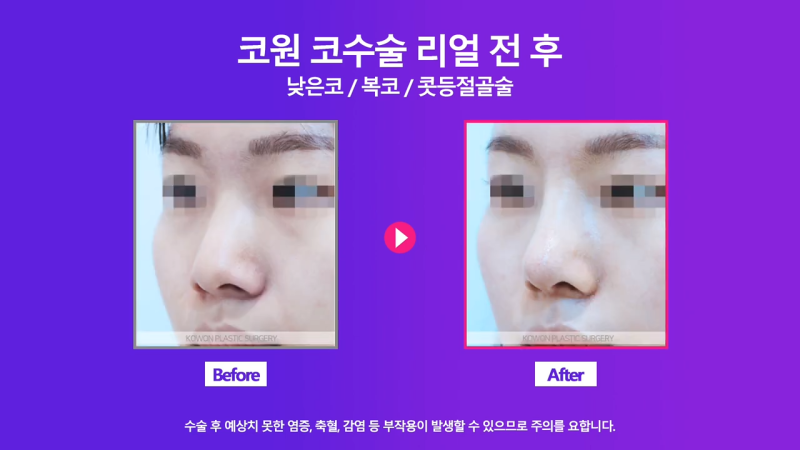 여자낮은코, 오똑한 코로 개선 성공한 사례 사진 7