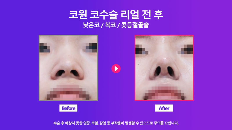 여자낮은코, 오똑한 코로 개선 성공한 사례 사진 8