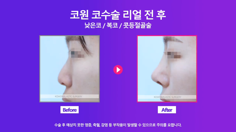 여자낮은코, 오똑한 코로 개선 성공한 사례 사진 5