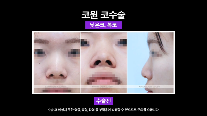 여자낮은코, 오똑한 코로 개선 성공한 사례 사진 4