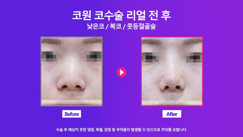여자낮은코, 오똑한 코로 개선 성공한 사례 사진 6