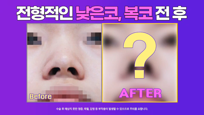 여자낮은코, 오똑한 코로 개선 성공한 사례
