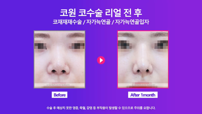 코재건수술 후 만족스럽지 못해 자가늑입자로 재수술한 사례 사진 5