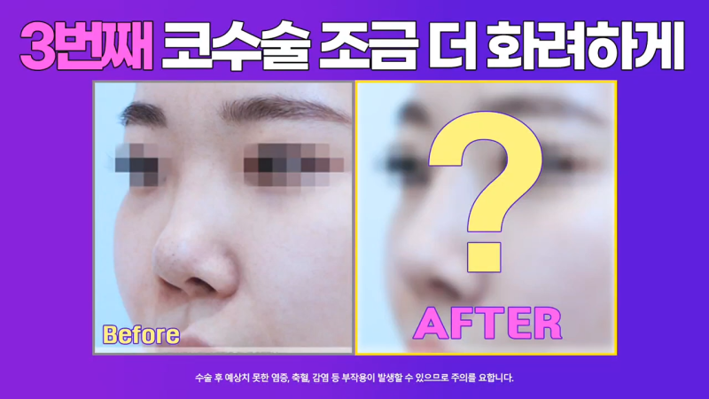 코재건수술 후 만족스럽지 못해 자가늑입자로 재수술한 사례