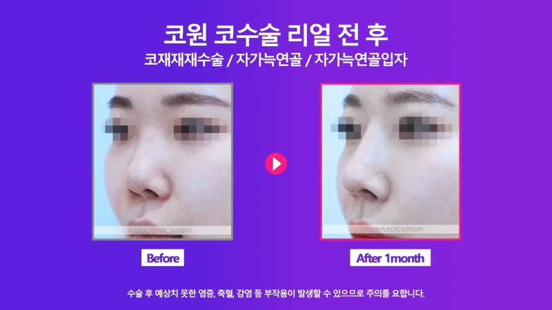 코재건수술 후 만족스럽지 못해 자가늑입자로 재수술한 사례 사진 7