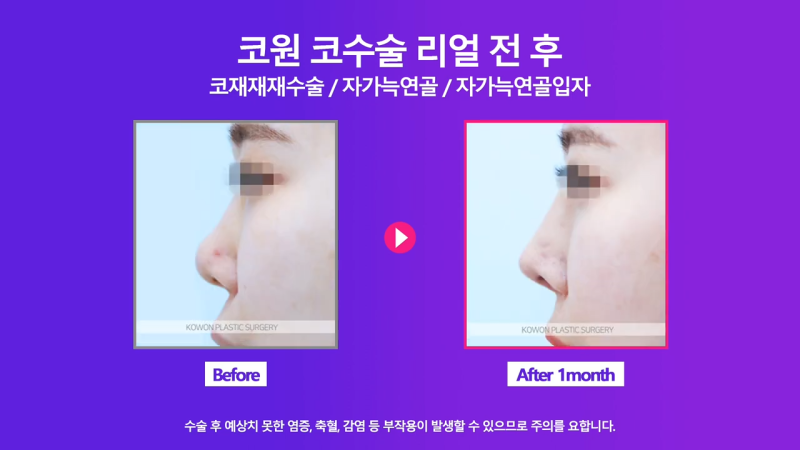 코재건수술 후 만족스럽지 못해 자가늑입자로 재수술한 사례 사진 8