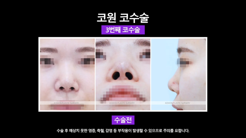 코재건수술 후 만족스럽지 못해 자가늑입자로 재수술한 사례 사진 4