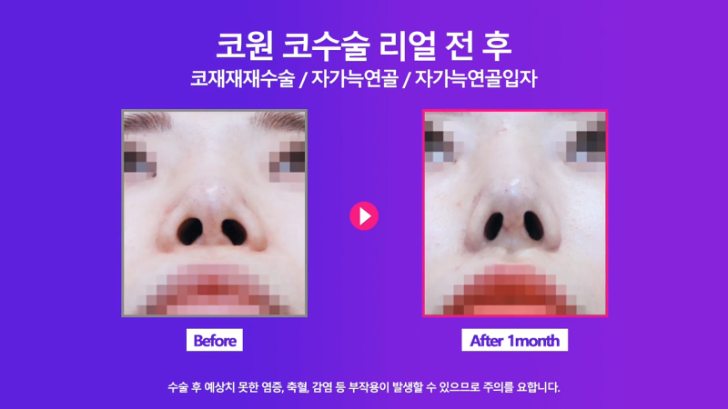 코재건수술 후 만족스럽지 못해 자가늑입자로 재수술한 사례 사진 6
