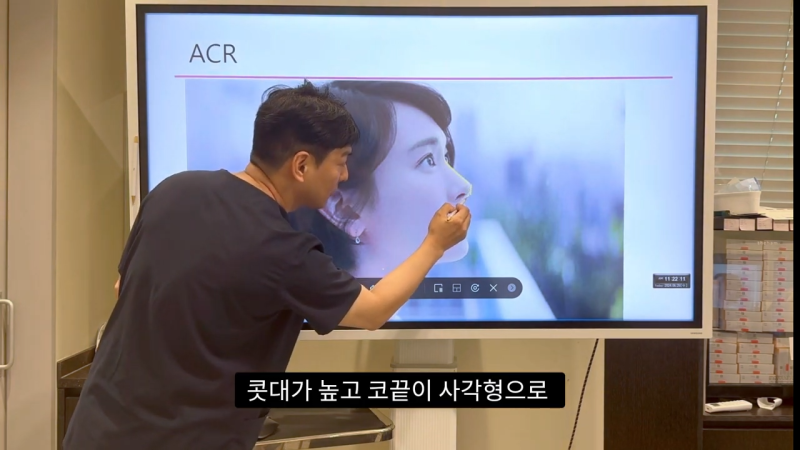 코 수술로 돌출입수술 효과를 얻을 수 있습니다! - 1편 사진 14